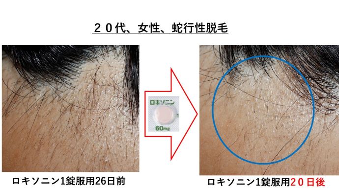 円形脱毛症　病院